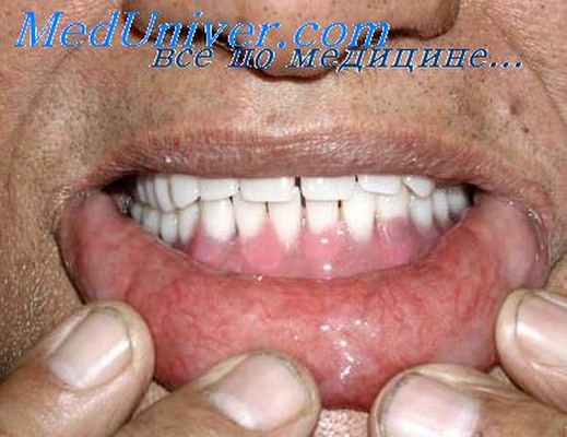 протезный стоматит