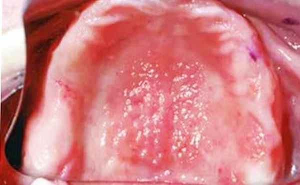 протезный стоматит 02