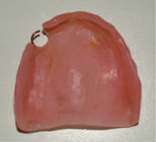 Налет желтого цвета на пластиночном протезе верхней челюсти фотография