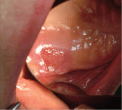 Язва слизистой оболочки неба фотография