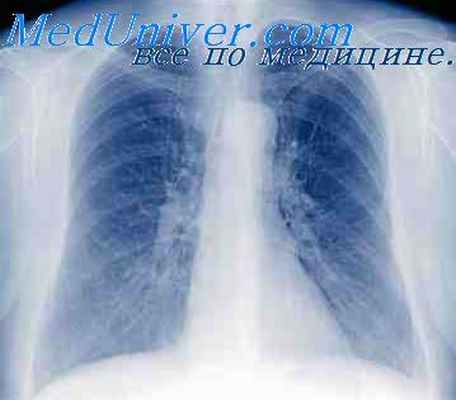 лимфогранулематоз