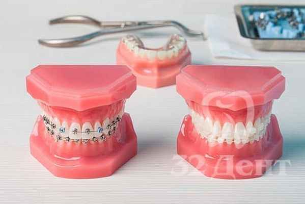 Классификация ортодонтических аппаратов