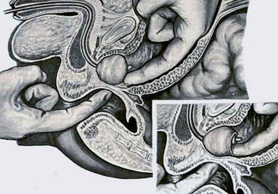 Аденомэктомия