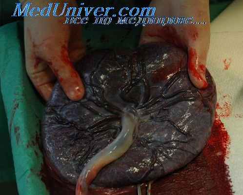 двуяйцевые двойни