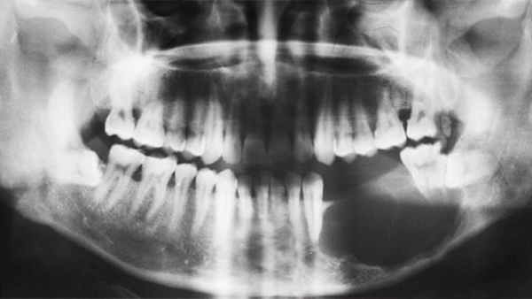 опухоли челюсти