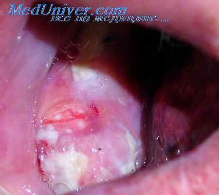 фиброма полости рта