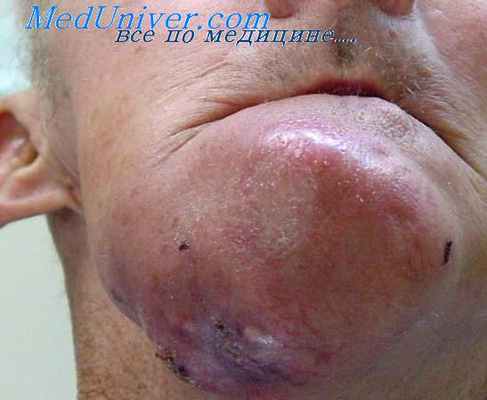 одонтогенная саркома