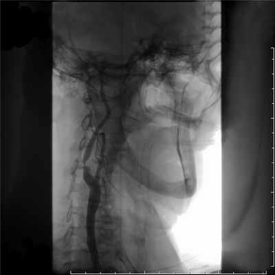 Стеноз сонной артерии 3 до.jpg