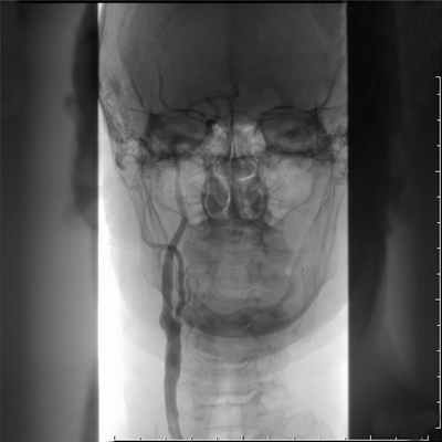 Стеноз сонной артерии 4 после.jpg