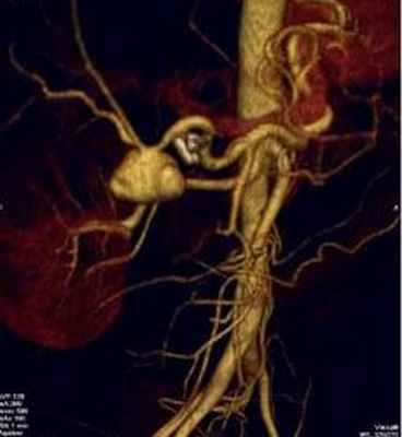 Аневризма печеночной артерии