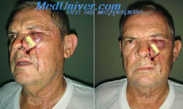 нейрогенная опухоль носа