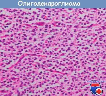 Олигодендроглиома