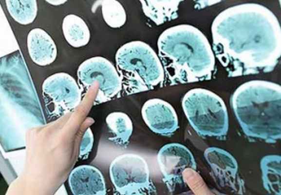 Лечение опухолей головного мозга