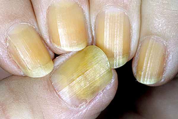 Грибок ногтей рук