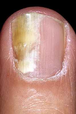 Грибок ногтей рук