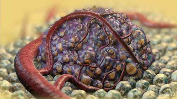 Злакачественные новообразования