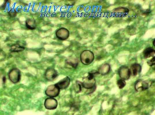 онхоцеркоз