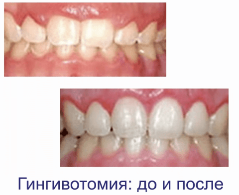 Гингивотомия: до и после