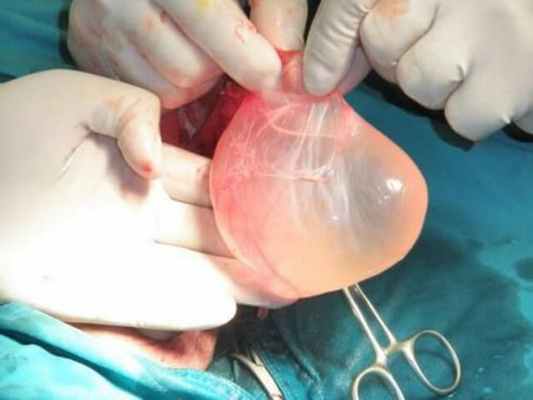 Операция Бергмана при водянке яичка