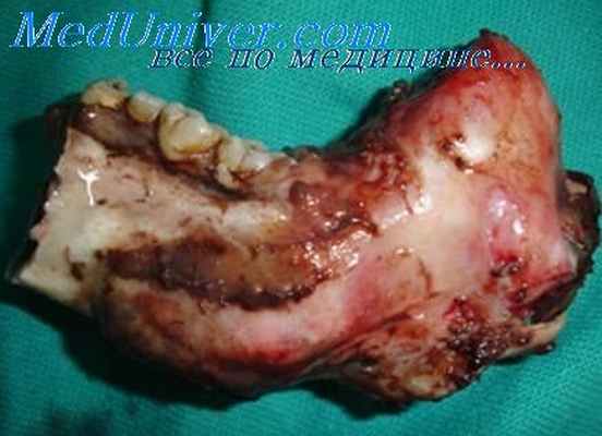 операция при амелобластоме