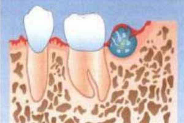 амелобластома челюсти 