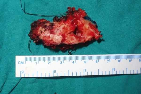 Рецидивирующая амелобластома: клинический случай