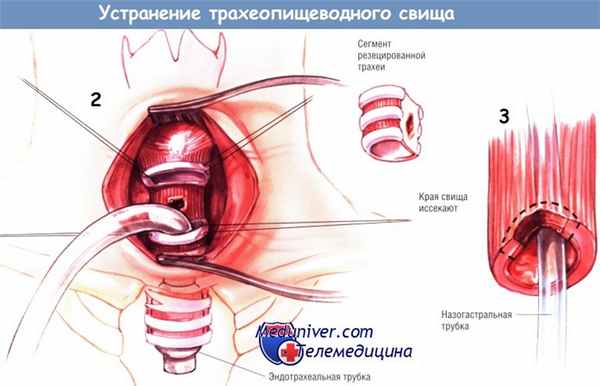 Методика и этапы устранения трахеопищеводного свища (ликвидации)