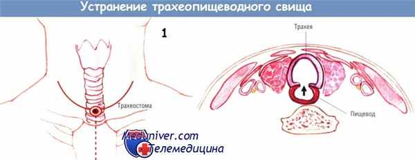 Методика и этапы устранения трахеопищеводного свища (ликвидации)