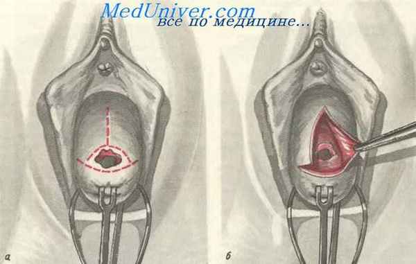 Операция Франца—Сундберга