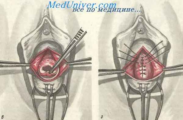 Операция Франца—Сундберга