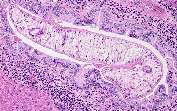 Описторхоз