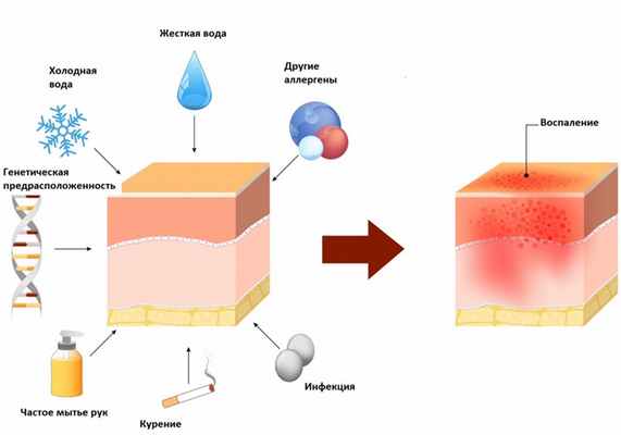 Причина дерматита.jpg