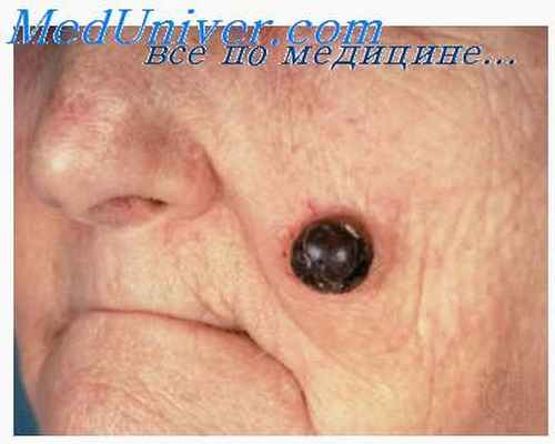 опухоль кожи