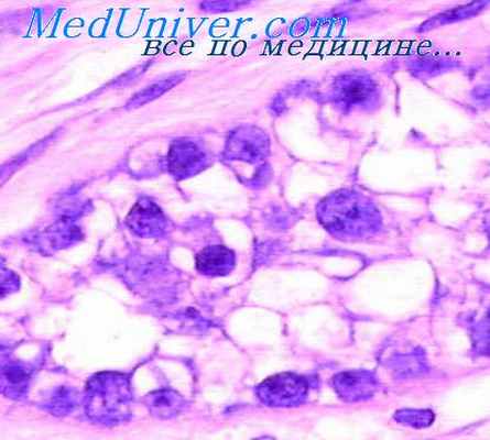 опухоли яичек