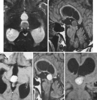 Опухоль шишковидной железы (пинеацитома) на МРТ