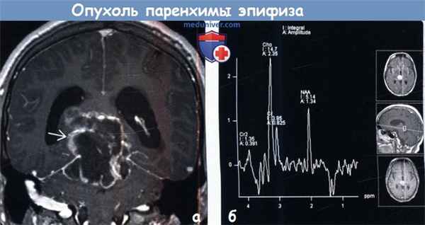 Опухоль паренхимы эпифиза промежуточной дифференцировки на МРТ