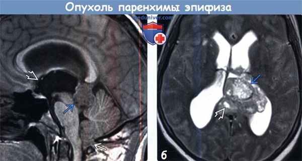 Опухоль паренхимы эпифиза промежуточной дифференцировки на МРТ