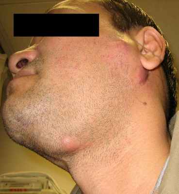 Лимфаденопатии при туберкулезе