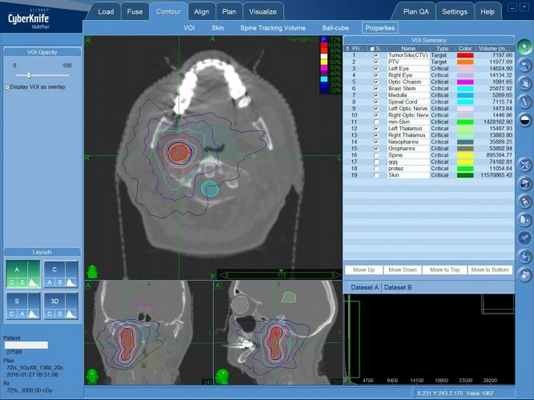 Безоперационное лечение параганглиомы на КиберНоже - план лечения