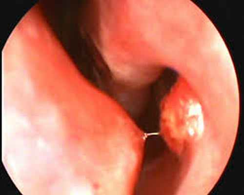 Гемангиома полости носа