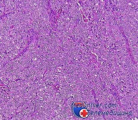 опухоли гортани