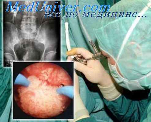 мочевой пузырь