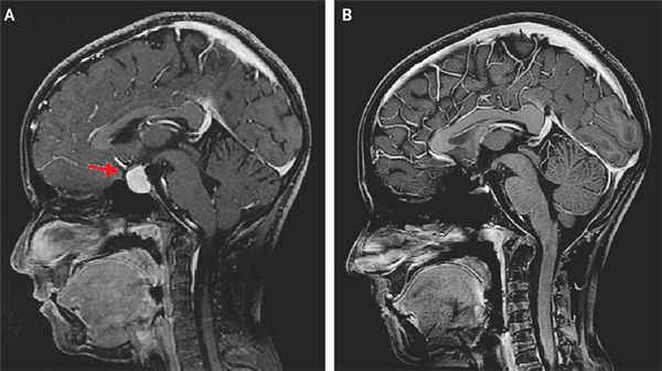аденома гипофиза