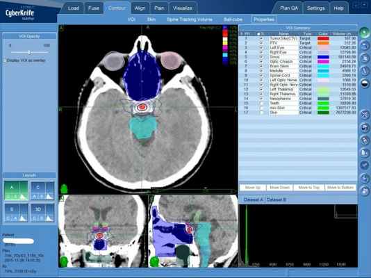 План лечения аденомы гипофиза на КиберНоже