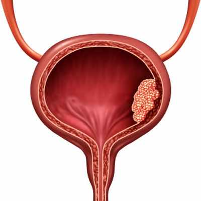 Опухоль мочевого пузыря