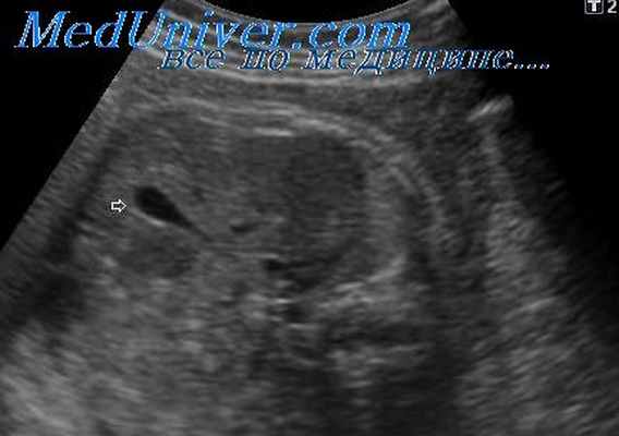 опухоль печени плода