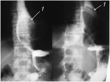Рентгенограмма пищевода с лейомиомой в его средней трети