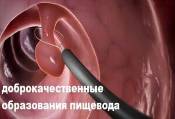 опухоль пищевода