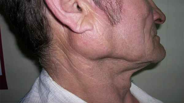 опухоли слюнных желез