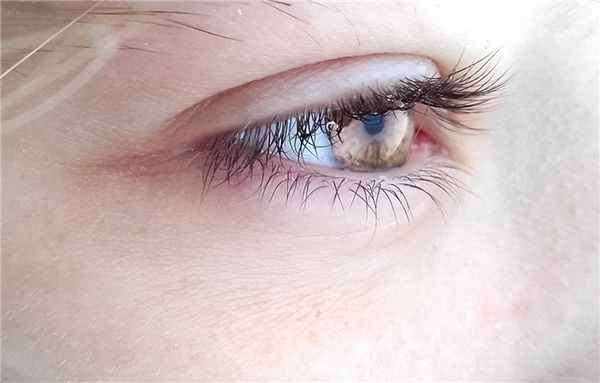 Опухоли на веках и в глазнице